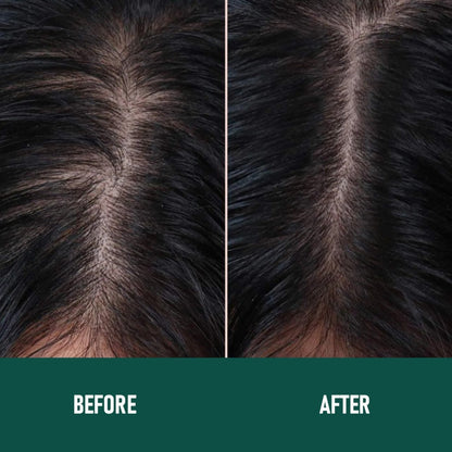 CH004 Minoxidil Anti-Hair Loss Mousse